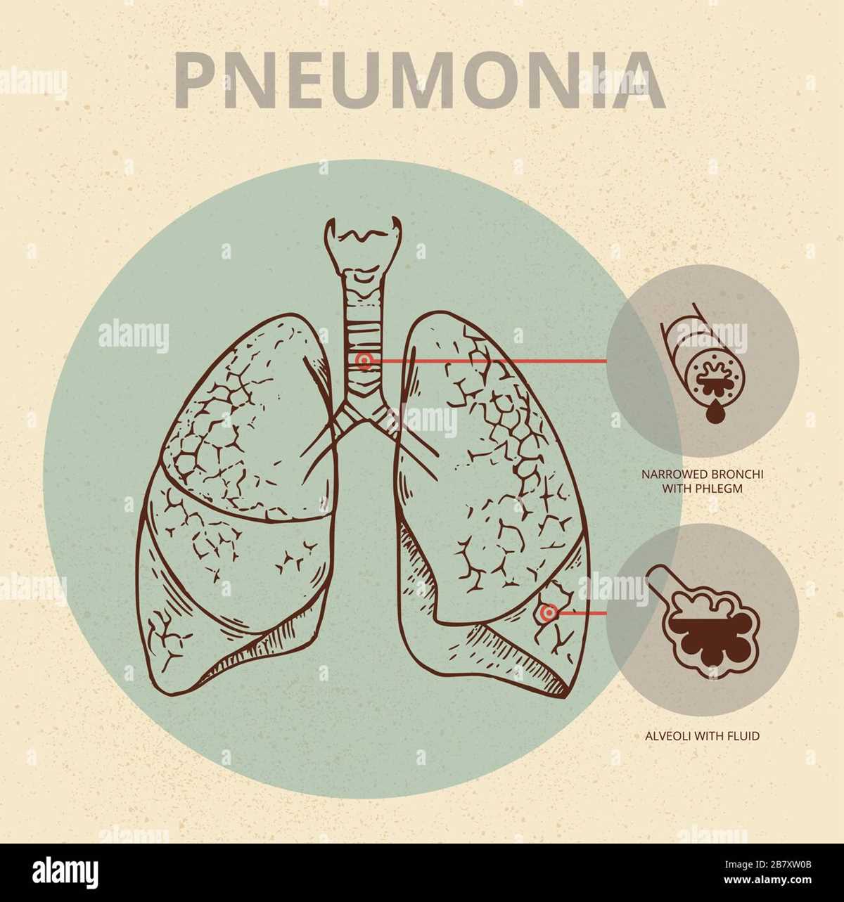 diarrhea schematic diagram