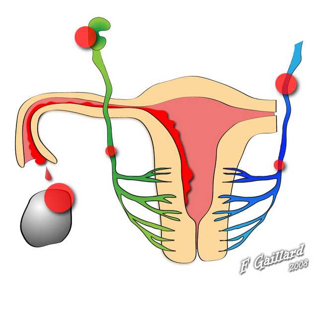 endometriosis schematic diagram endometriosis schematic diagram