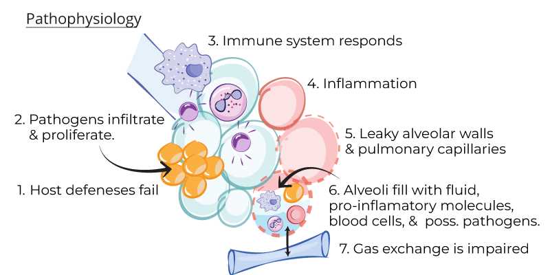 pathophysiology of community acquired pneumonia schematic diagram