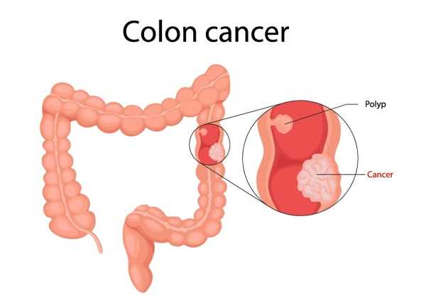 colorectal cancer schematic diagram colorectal cancer schematic diagram