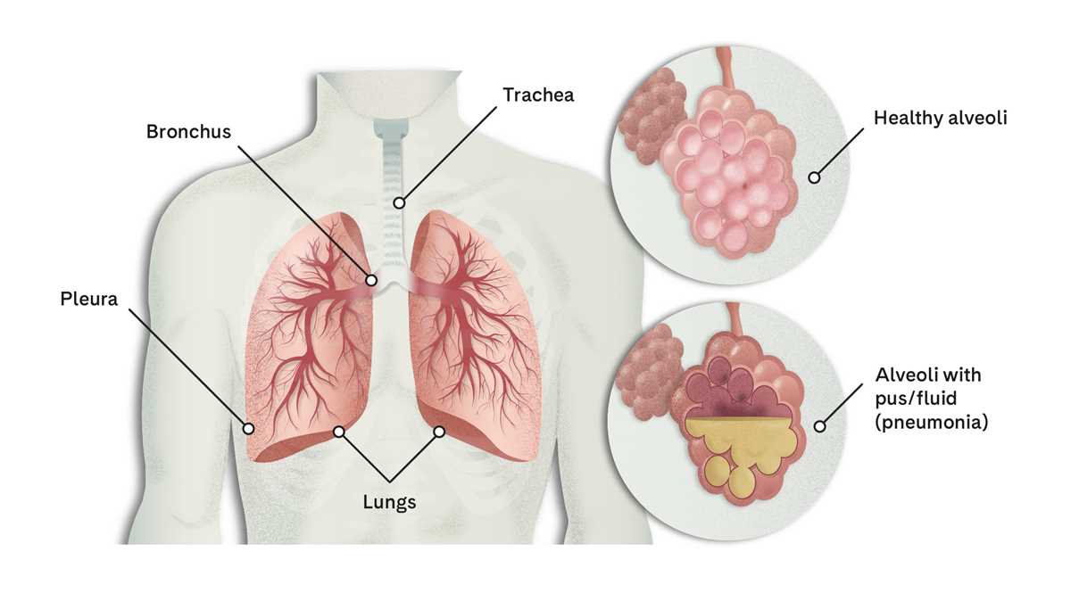 community acquired pneumonia schematic diagram community acquired pneumonia schematic diagram