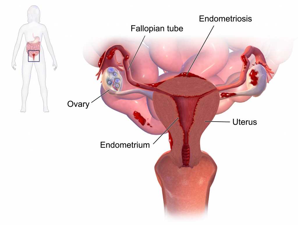 endometriosis schematic diagram endometriosis schematic diagram