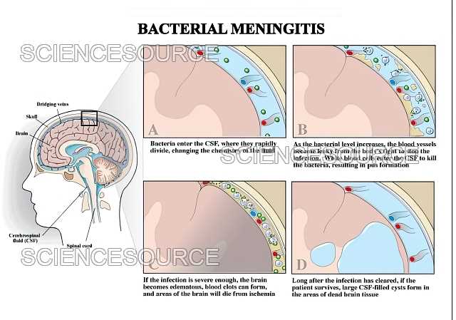 schematic diagram pathophysiology of bacterial meningitis