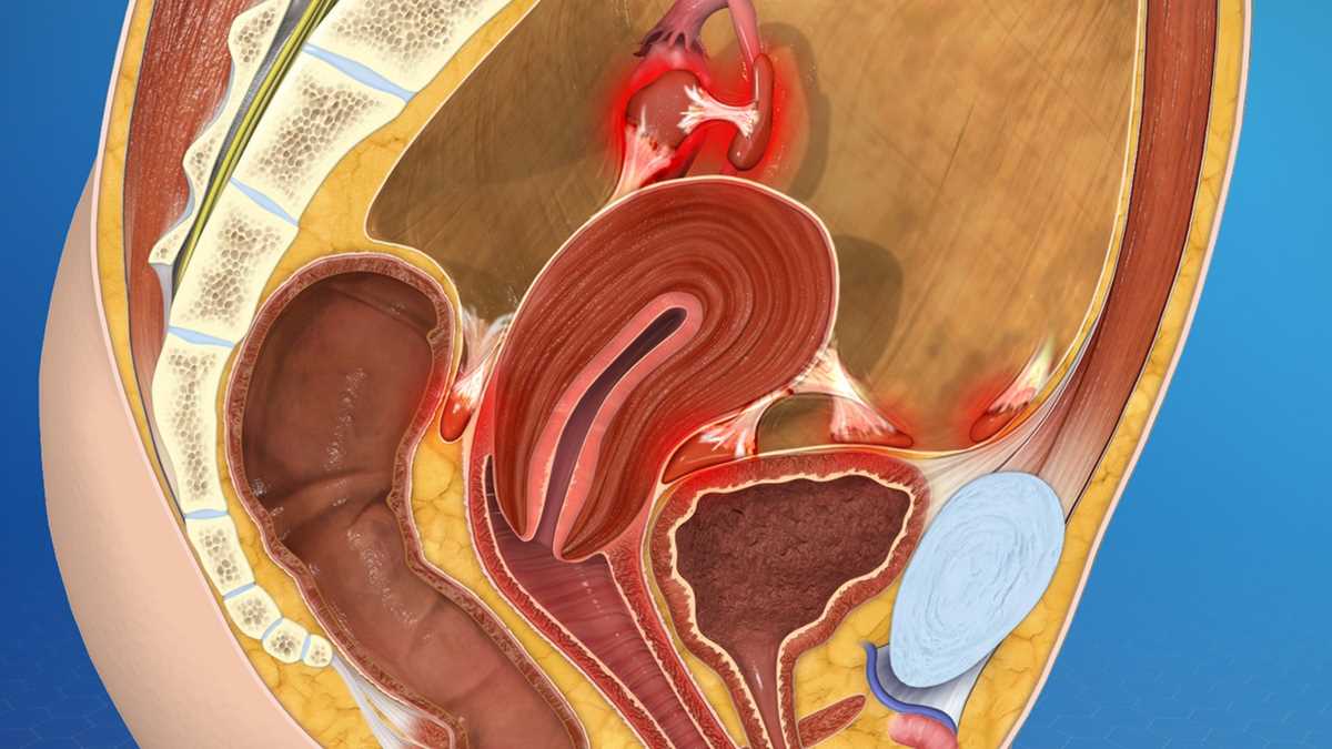 endometriosis schematic diagram endometriosis schematic diagram