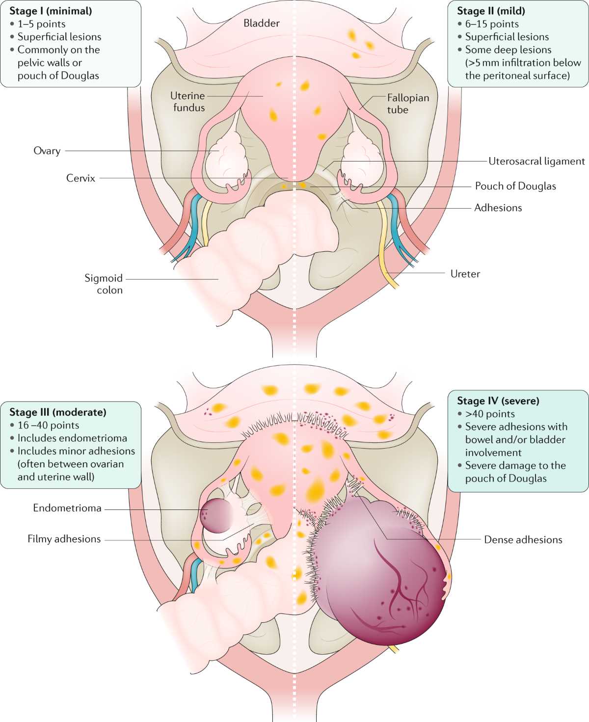 endometriosis schematic diagram endometriosis schematic diagram